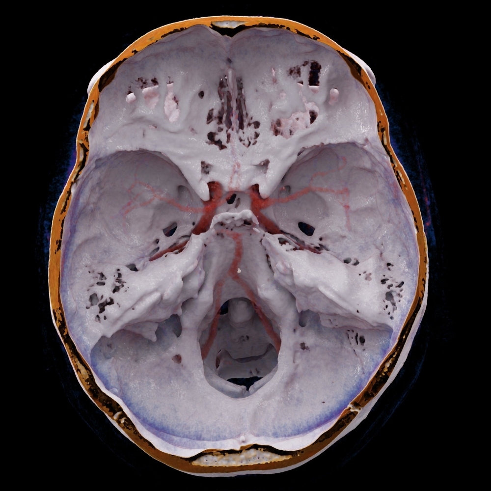 Angioscanner des troncs supra aortiques