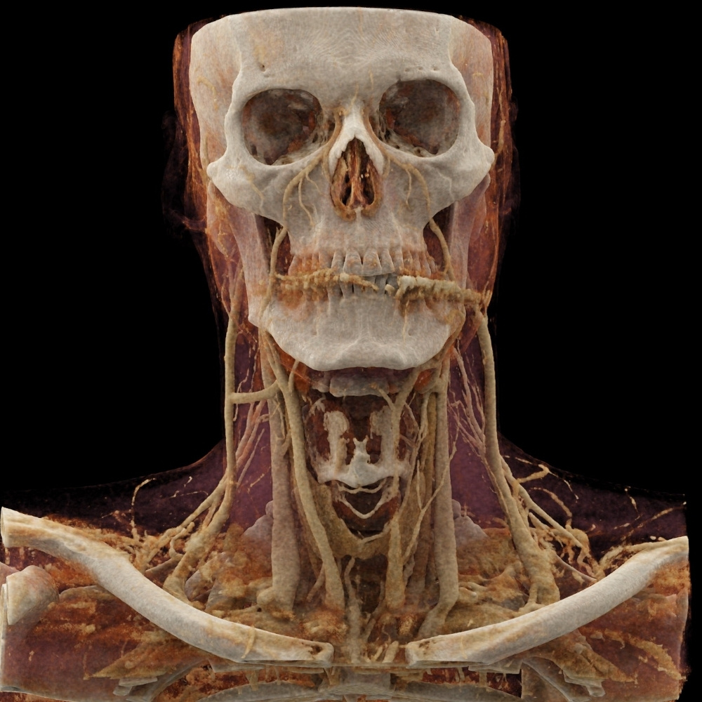 Angioscanner des troncs supra aortiques
