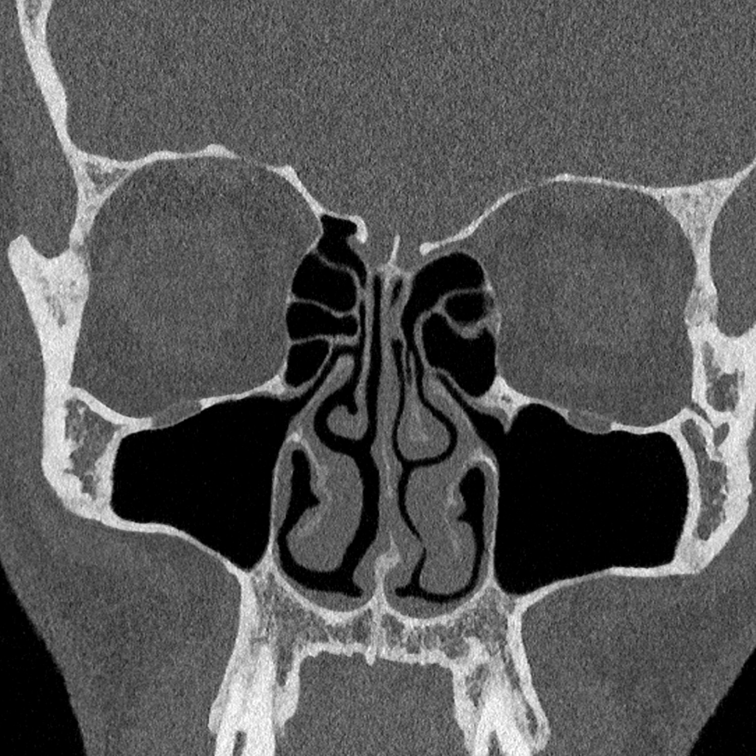 scanner des sinus