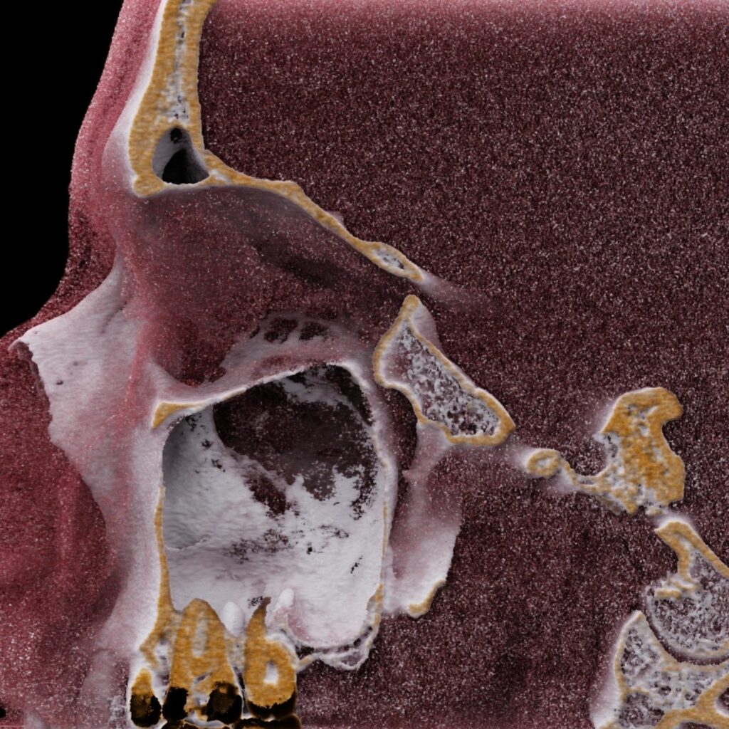 scanner des sinus